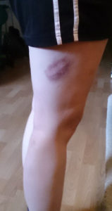 #4 Bruise!